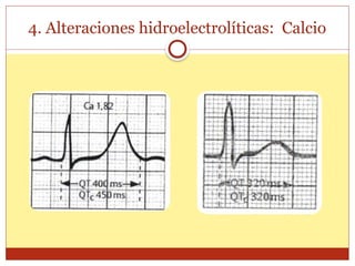 4. Alteraciones hidroelectrolíticas: Calcio
 