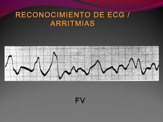 FV
RECONOCIMIENTO DE ECG /RECONOCIMIENTO DE ECG /
ARRITMIASARRITMIAS
 