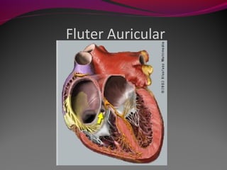 Fluter Auricular
 