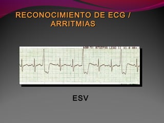 ESV
RECONOCIMIENTO DE ECG /RECONOCIMIENTO DE ECG /
ARRITMIASARRITMIAS
 