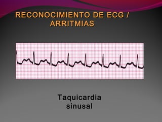 Taquicardia
sinusal
RECONOCIMIENTO DE ECG /RECONOCIMIENTO DE ECG /
ARRITMIASARRITMIAS
 