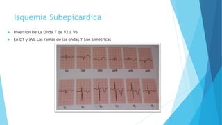 Isquemia Subepicardica
 Inversion De La Onda T de V2 a V6
 En D1 y aVL Las ramas de las ondas T Son Simetricas
 