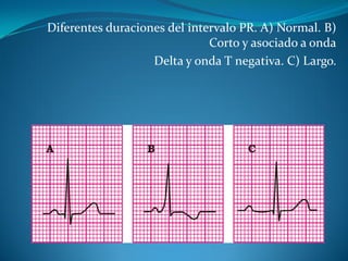 Diferentes duraciones del intervalo PR. A) Normal. B)
Corto y asociado a onda
Delta y onda T negativa. C) Largo.
 