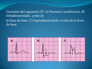 Variantes del segmento ST. A) Normal o isoeléctrico, B)
Infradesnivelado, 3 mm de
la línea de base. C) Supradesnivelado, 6 mm de la línea
de base
 