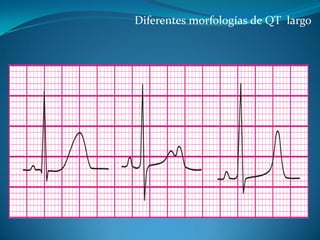 Diferentes morfologías de QT largo
 