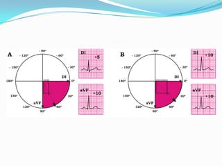 Electrocardiograma normal 