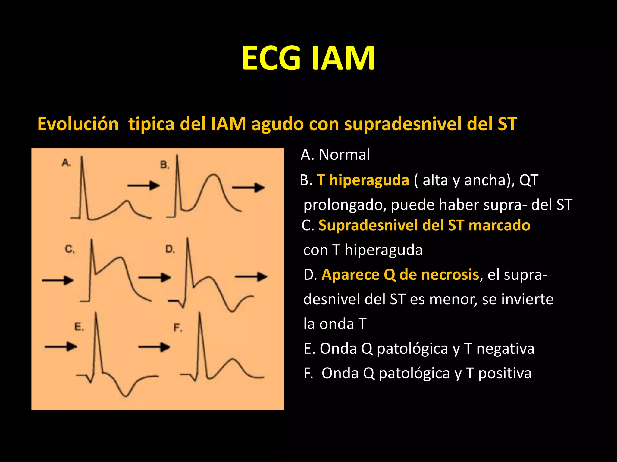 Electrocardiograma En IAM 2015 PPT electrocardiograma-en-iam-2015-ppt