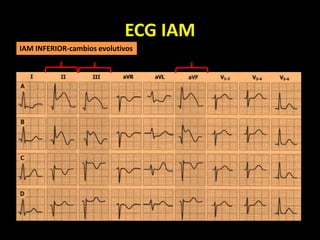 ECG IAM
IAM INFERIOR-cambios evolutivos
 