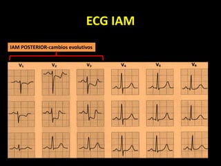 ECG IAM
IAM POSTERIOR-cambios evolutivos
 