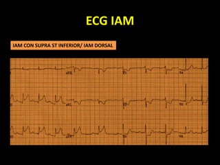 ECG IAM
IAM CON SUPRA ST INFERIOR/ IAM DORSAL
 