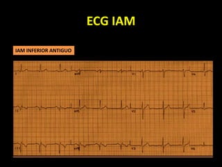 ECG IAM
IAM INFERIOR ANTIGUO
 