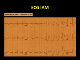ECG IAM
IAM INFEROPOSTERIOR AGUDO
 