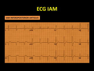ECG IAM
IAM INFEROPOSTERIOR ANTIGUO
 