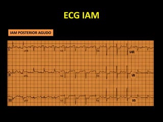 ECG IAM
IAM POSTERIOR AGUDO
 