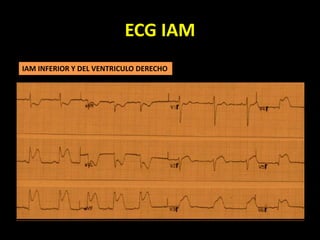 ECG IAM
IAM INFERIOR Y DEL VENTRICULO DERECHO
 