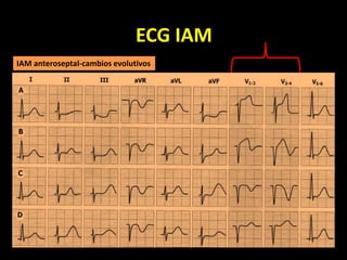 ECG IAM
IAM anteroseptal-cambios evolutivos
 