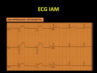 ECG IAM
IAM HIPERAGUDO ANTEROSEPTAL
 