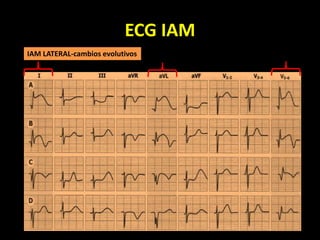 ECG IAM
IAM LATERAL-cambios evolutivos
 