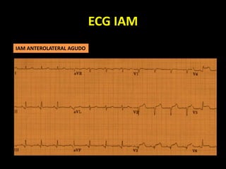 ECG IAM
IAM ANTEROLATERAL AGUDO
 