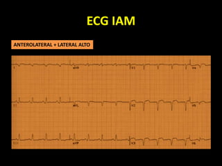 ECG IAM
ANTEROLATERAL + LATERAL ALTO
 