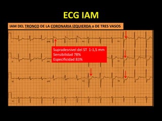 ECG IAM
IAM DEL TRONCO DE LA CORONARIA IZQUIERDA o DE TRES VASOS
Supradesnivel del ST 1-1,5 mm
Sensibilidad 78%
Especificidad 83%
 