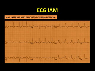ECG IAM
IAM INFERIOR MAS BLOQUEO DE RAMA DERECHA
 