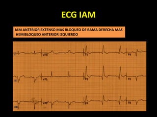 ECG IAM
IAM ANTERIOR EXTENSO MAS BLOQUEO DE RAMA DERECHA MAS
HEMIBLOQUEO ANTERIOR IZQUIERDO
 