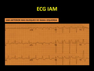 ECG IAM
IAM ANTERIOR MAS BLOQUEO DE RAMA IZQUIERDA
 