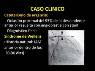 CASO CLINICO
Cateterismo de urgencia:
Oclusión proximal del 95% de la descendente
anterior resuelta con angioplastia con stent.
Diagnóstico final:
Síndrome de Wellens
(Historia natural: IAM
anterior dentro de los
30-90 dias)
 