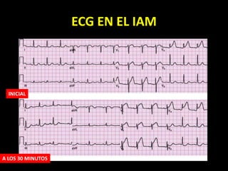 ECG EN EL IAM
INICIAL
A LOS 30 MINUTOS
 
