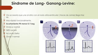 Electrocardiograma en los síndromes de preexitacion.pptx