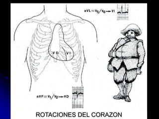 Electrocardiograma NormalPosición HorizontalVI: Porción Inferior Izq. >>> aVL = V5-V6       VD: Cara Inferior >>> aVF = V1-V2Posición VerticalVI: Cara Inferior >>> aVF = V5-V6       VD: Torax Anterior >>> aVL = V1-V2-Brevilineos-Embarazadas-HVI-Longilineos-HVD