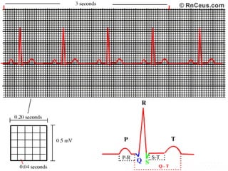 RitmoFrecuencia cardiacaIntervalo PQComplejo QRSIntervalo QT:	QT prolongado: K ↓   Ca ↓ Mag. ↓     Drogas: Amiod., Quinidina    Niños: Con sordera -> S. Jerwell. Landge. Nielsen.               Sin sordera -> S. Romano Ward. QT  corto: Insuficiencia coronaria aguda y acción digitálica.                              K ↑ Ca. ↑Segmento: ST ↑ o ↓                          Variaciones > 1mv < 0.5mv	Onda ST: + en todas las derivaciones, excepto: aVR, aVL, a veces en un corazón V.  Mujeres y niños en precordiales derechas.  Sus alteraciones son de tipo cualitativos. Signo más común de las ICO, CMP HPTF no obst. asimétricasEje eléctricoPrecordiales