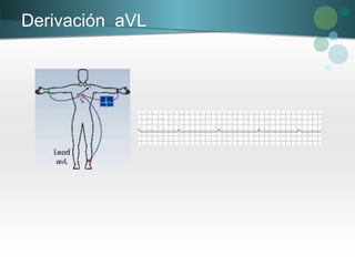Derivación aVL
 