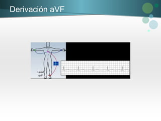 Derivación aVF
 