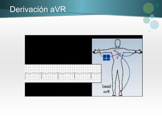 Derivación aVR
 