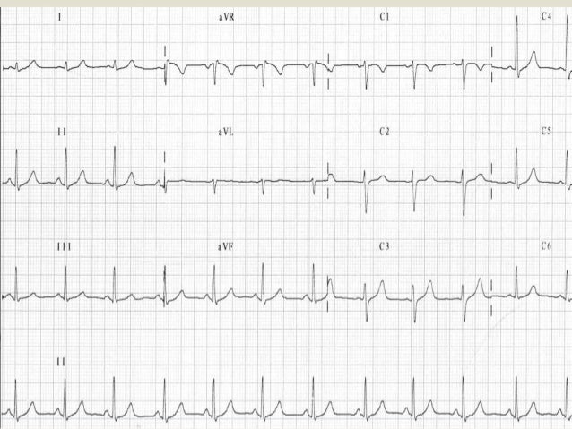 Resultado de imagen de ELECTROCARDIOGRAMA NORMAL