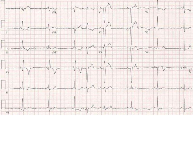 Electrocardiograma normal.