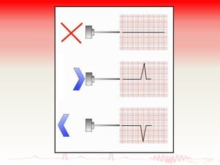ELECTROCARDIOGRAMA NORMAL | PPTX