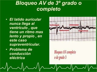 Electrocardiograma y arritmia