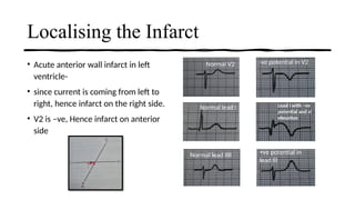 ELECTROCARDIOGRAM CHANGES DURING MYOCARDIAL INFARCTION.pptx