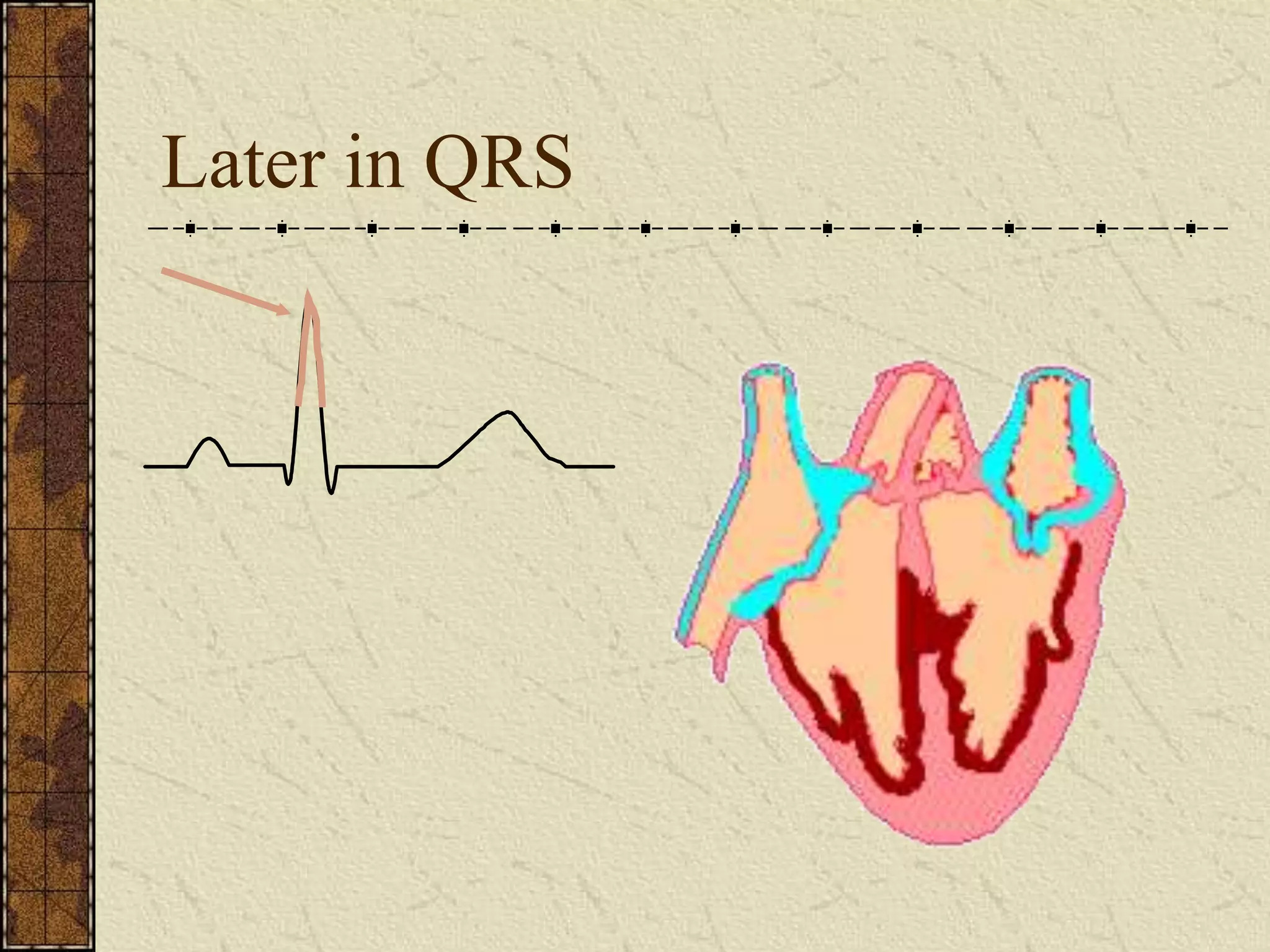 Later in QRS
 