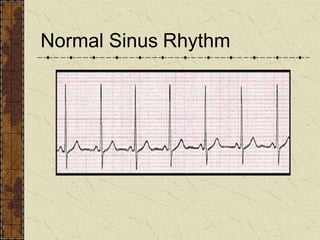 Sinus Rhy Electrocardiogram(ecg) | PPT