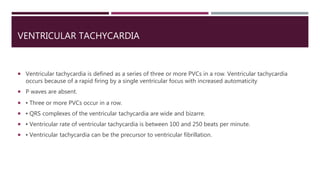VENTRICULAR TACHYCARDIA
 Ventricular tachycardia is defined as a series of three or more PVCs in a row. Ventricular tachycardia
occurs because of a rapid firing by a single ventricular focus with increased automaticity
 P waves are absent.
 ▪ Three or more PVCs occur in a row.
 ▪ QRS complexes of the ventricular tachycardia are wide and bizarre.
 ▪ Ventricular rate of ventricular tachycardia is between 100 and 250 beats per minute.
 ▪ Ventricular tachycardia can be the precursor to ventricular fibrillation.
 