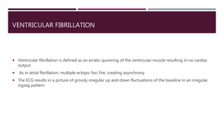 VENTRICULAR FIBRILLATION
 Ventricular fibrillation is defined as an erratic quivering of the ventricular muscle resulting in no cardiac
output.
 As in atrial fibrillation, multiple ectopic foci fire, creating asynchrony.
 The ECG results in a picture of grossly irregular up and down fluctuations of the baseline in an irregular
zigzag pattern
 