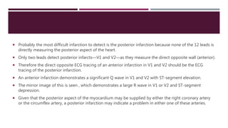  Probably the most difficult infarction to detect is the posterior infarction because none of the 12 leads is
directly measuring the posterior aspect of the heart.
 Only two leads detect posterior infarcts—V1 and V2—as they measure the direct opposite wall (anterior).
 Therefore the direct opposite ECG tracing of an anterior infarction in V1 and V2 should be the ECG
tracing of the posterior infarction.
 An anterior infarction demonstrates a significant Q wave in V1 and V2 with ST-segment elevation.
 The mirror image of this is seen , which demonstrates a large R wave in V1 or V2 and ST-segment
depression.
 Given that the posterior aspect of the myocardium may be supplied by either the right coronary artery
or the circumflex artery, a posterior infarction may indicate a problem in either one of these arteries.
 