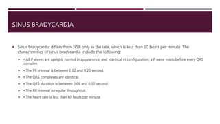 SINUS BRADYCARDIA
 Sinus bradycardia differs from NSR only in the rate, which is less than 60 beats per minute. The
characteristics of sinus bradycardia include the following:
 ▪ All P waves are upright, normal in appearance, and identical in configuration; a P wave exists before every QRS
complex.
 ▪ The PR interval is between 0.12 and 0.20 second.
 ▪ The QRS complexes are identical.
 ▪ The QRS duration is between 0.06 and 0.10 second.
 ▪ The RR interval is regular throughout.
 ▪ The heart rate is less than 60 beats per minute.
 