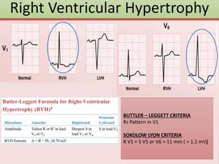 Right Ventricular Hypertrophy
BUTTLER – LEGGETT CRITERIA
Rs Pattern in V1
SOKOLOW LYON CRITERIA
R V1 + S V5 or V6 > 11 mm ( > 1.1 mV)
 