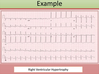 Example
Right Ventricular Hypertrophy
 