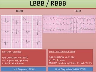 LBBB / RBBB
RBBB LBBB
STRICT CRITERIA FOR LBBB
QRS DURATION > 0.12 SEC
V1 QS, Rs wave
Mid QRS notching in 2 leads L1, aVL, V5, V6
CRITERIA FOR RBBB
QRS DURATION > 0.12 SEC
V1: R’ peak, RsR, qR wave
L1 & V6: wide S wave
Limit Diagnosis of LVH & STEMI
Limit Diagnosis of RVH
 